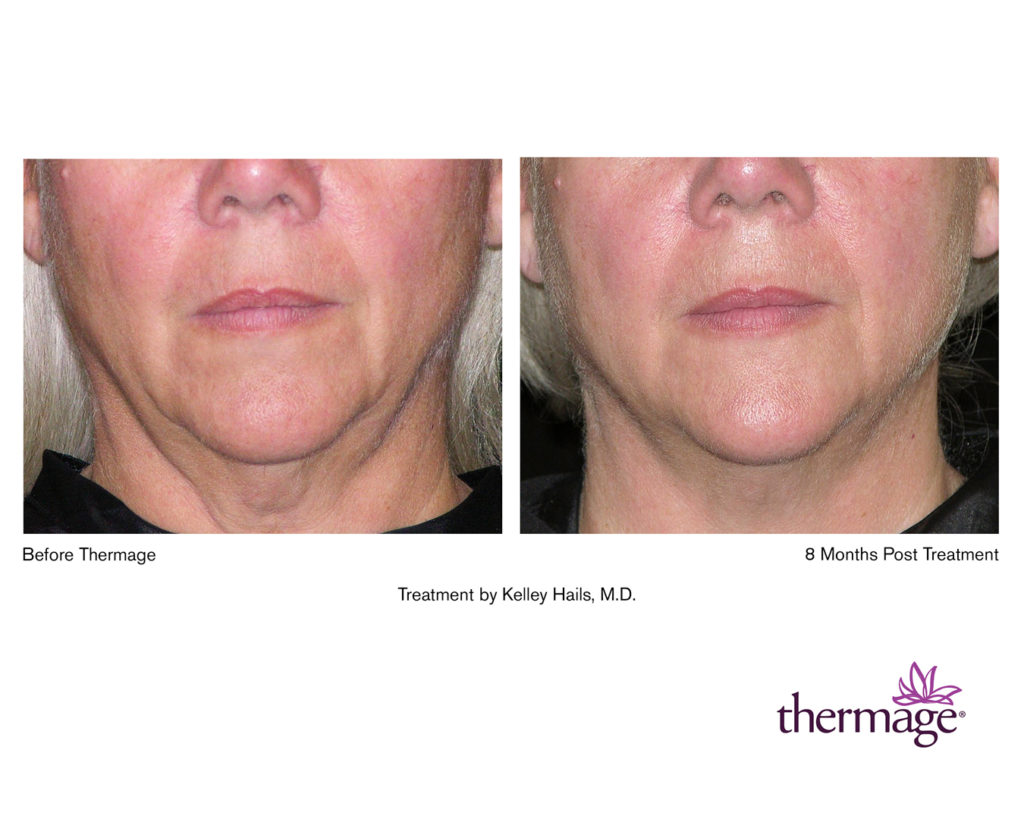 thermage_2 Cosmetic Laser Centers