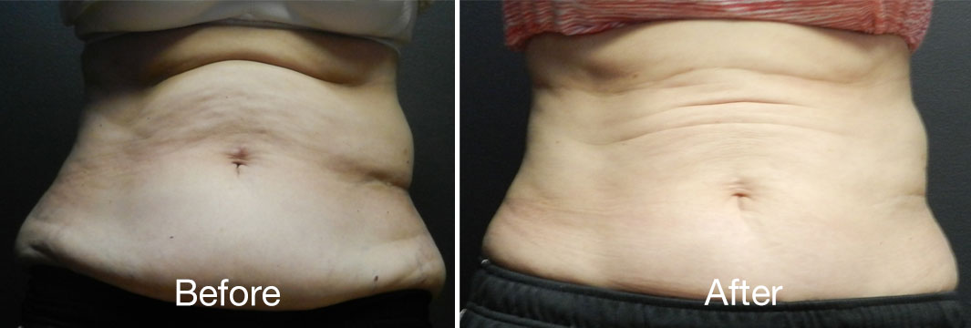 CoolSculpting® at Cosmetic Laser Centers in Pittsburgh