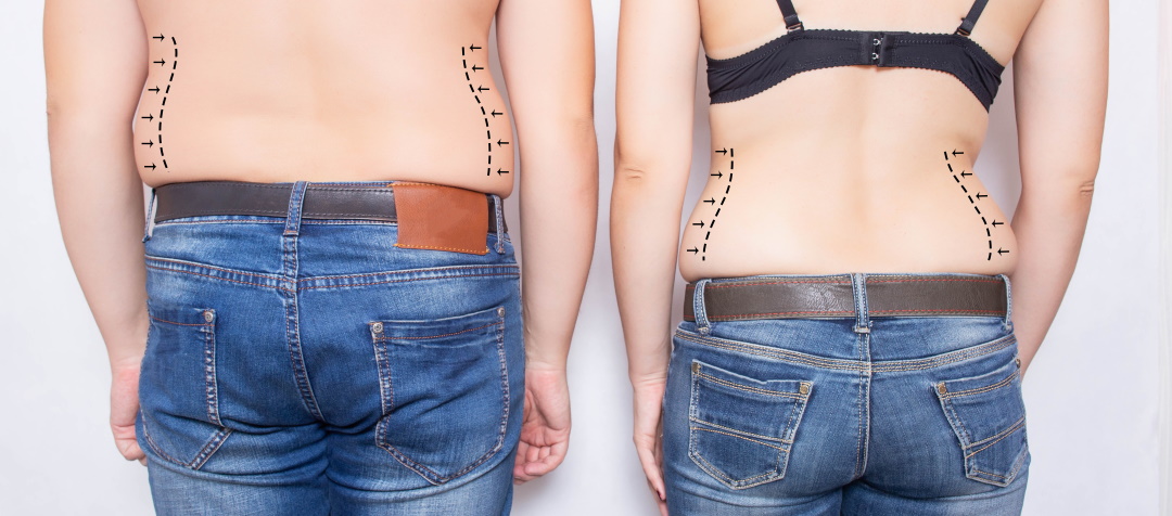 CoolSculpting Treatments