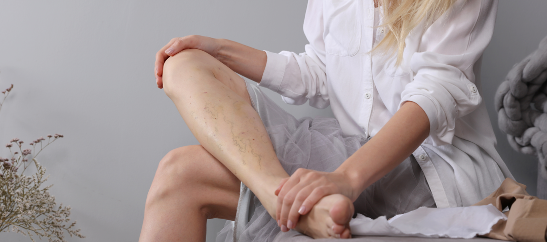 women with spider veins on her leg