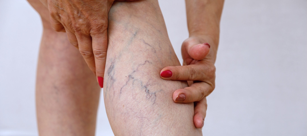 An elderly woman touching the spider veins on her legs